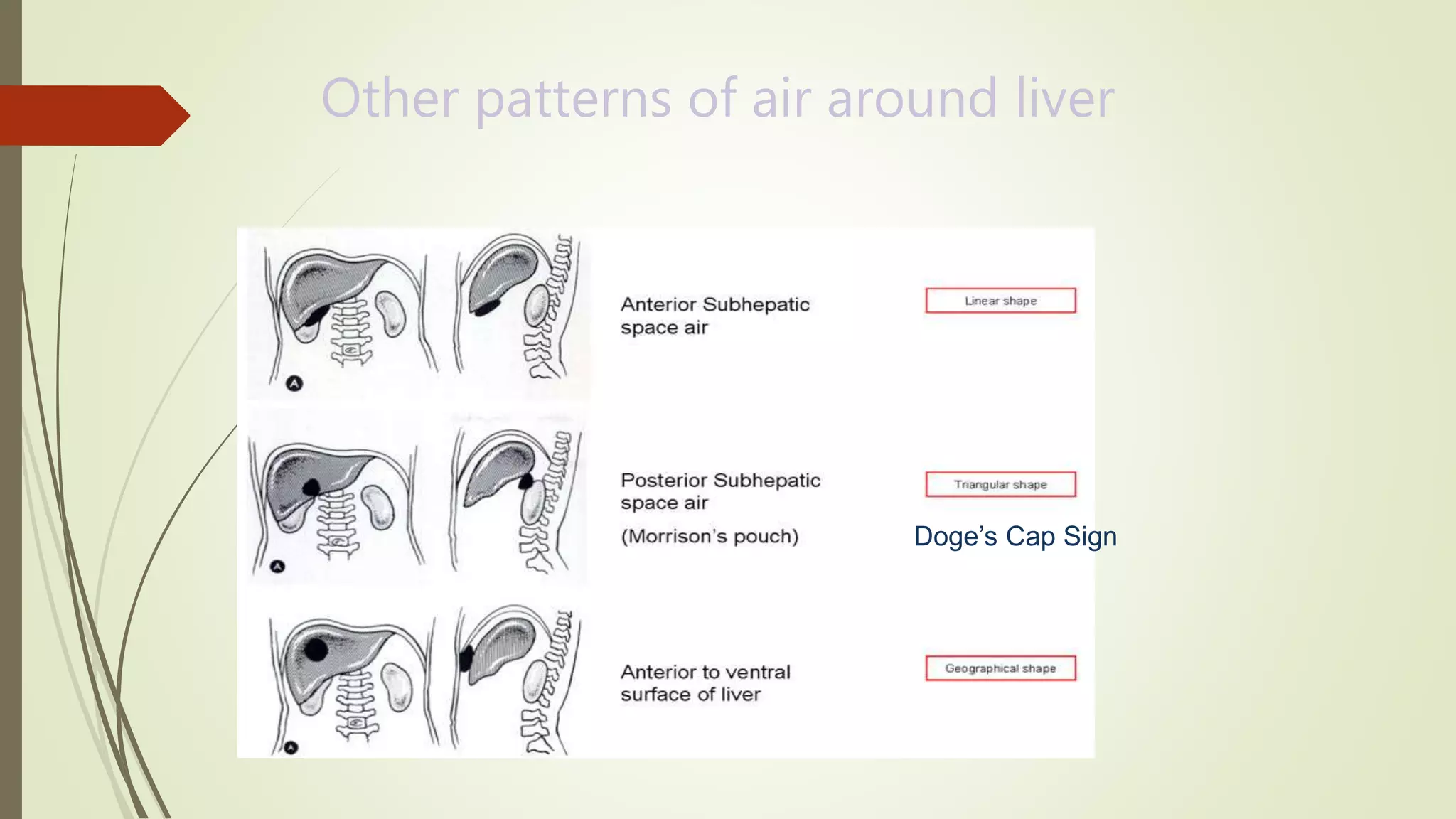 Abdominal x-ray interpretation ppt | PPTX
