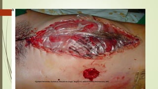 *Quintero Hernandez, Gustavo A, Infección en cirugia . Bogota D.C, editorial Medica Panamericana, 2001.
 