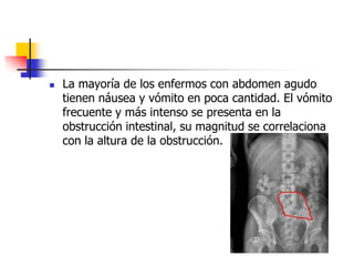 La mayoría de los enfermos con abdomen agudo tienen náusea y vómito en poca cantidad. El vómito frecuente y más intenso se presenta en la obstrucción intestinal, su magnitud se correlaciona con la altura de la obstrucción. 