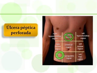 Úlcera péptica
  perforada
 