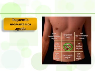 Isquemia
mesentérica
   aguda
 