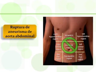Ruptura de
 aneurisma de
aorta abdominal
 