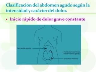 Clasificación del abdomen agudo según la
intensidad y carácter del dolor.
   Inicio rápido de dolor grave constante
 