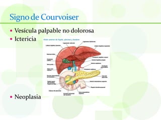 Signo de Courvoiser
 Vesícula palpable no dolorosa
 Ictericia




 Neoplasia
 