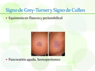 Signo de Grey-Turner y Signo de Cullen
 Equimosis en flancos y periumbilical




 Pancreatitis aguda, hemoperitoneo
 