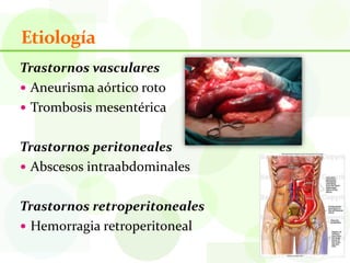 Etiología
Trastornos vasculares
 Aneurisma aórtico roto
 Trombosis mesentérica


Trastornos peritoneales
 Abscesos intraabdominales


Trastornos retroperitoneales
 Hemorragia retroperitoneal
 