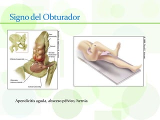 Signo del Obturador




 Apendicitis aguda, absceso pélvico, hernia
 