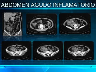ABDOMEN AGUDO INFLAMATORIO 
