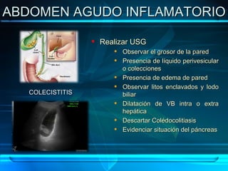 ABDOMEN AGUDO INFLAMATORIO COLECISTITIS Realizar USG Observar el grosor de la pared Presencia de líquido perivesicular o colecciones Presencia de edema de pared Observar litos enclavados y lodo biliar Dilatación de VB intra o extra hepática Descartar Colédocolitiasis Evidenciar situación del páncreas 