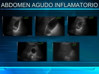 ABDOMEN AGUDO INFLAMATORIO 