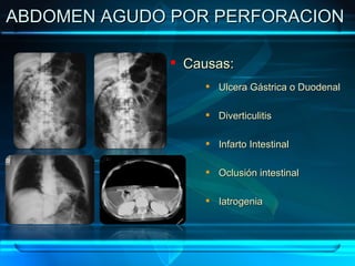 ABDOMEN AGUDO POR PERFORACION  Causas: Ulcera Gástrica o Duodenal Diverticulitis Infarto Intestinal Oclusión intestinal Iatrogenia 