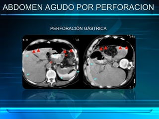 ABDOMEN AGUDO POR PERFORACION  PERFORACIÓN GÁSTRICA 