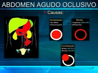 ABDOMEN AGUDO OCLUSIVO Causas: 