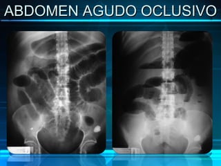 ABDOMEN AGUDO OCLUSIVO 