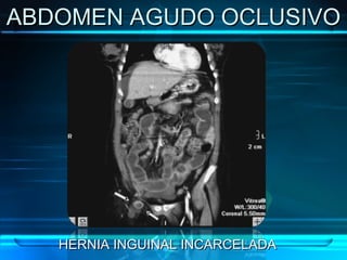 ABDOMEN AGUDO OCLUSIVO HERNIA INGUINAL INCARCELADA 
