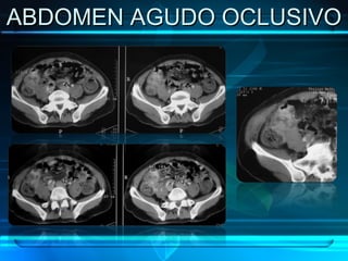 ABDOMEN AGUDO OCLUSIVO 