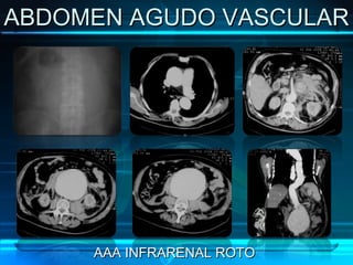 ABDOMEN AGUDO VASCULAR AAA INFRARENAL ROTO 