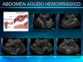 ABDOMEN AGUDO HEMORRÁGICO 