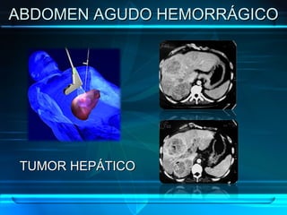 ABDOMEN AGUDO HEMORRÁGICO TUMOR HEPÁTICO 