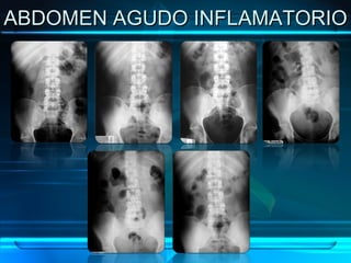 ABDOMEN AGUDO INFLAMATORIO 