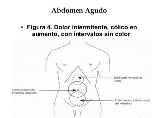 Abdomen Agudo
• Figura 4. Dolor intermitente, cólico en
aumento, con intervalos sin dolor
 