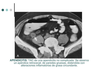APENDICITIS. TAC de una apendicitis no complicada. Se observa
un apéndice retrocecal, de paredes gruesas, distendida con
alteraciones inflamatorias de grasa circundante.

 