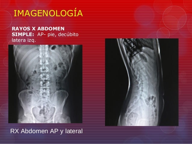 Abdomen agudo
