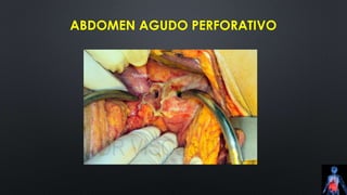 ABDOMEN AGUDO PERFORATIVO
 