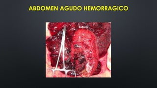 ABDOMEN AGUDO HEMORRAGICO
 