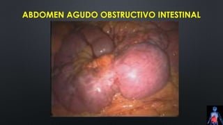ABDOMEN AGUDO OBSTRUCTIVO INTESTINAL
 