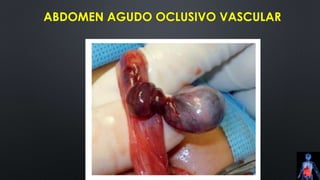 ABDOMEN AGUDO OCLUSIVO VASCULAR
 