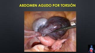 ABDOMEN AGUDO POR TORSIÓN
 
