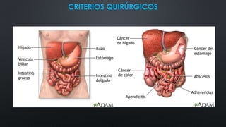 CRITERIOS QUIRÚRGICOS
 