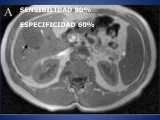 SENSIBILIDAD 80%
ESPECIFICIDAD 60%
 