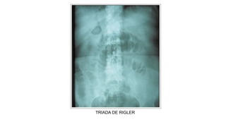Sdinal De Rigler ABDOMEN_AGUDO e suas complicaciones y tratamiento | PPTX