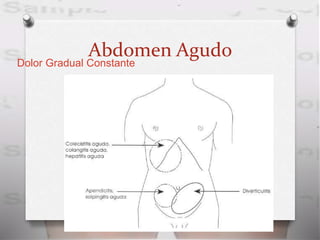 Abdomen Agudo
Dolor Gradual Constante
 