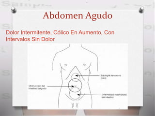 Abdomen Agudo
Dolor Intermitente, Cólico En Aumento, Con
Intervalos Sin Dolor
 