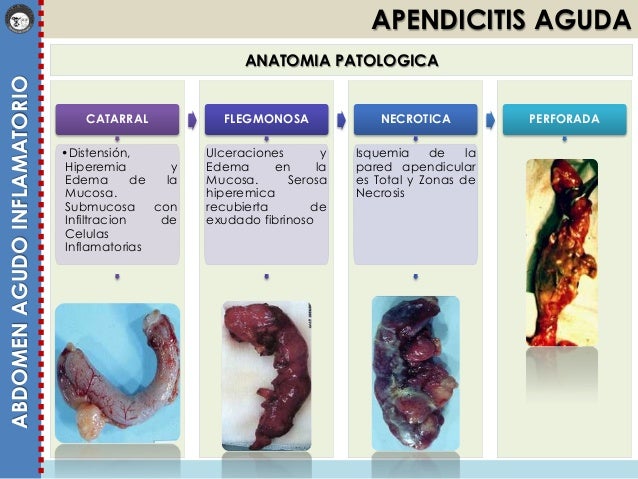 Resultado de imagen para tipos de apendicitis