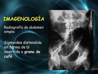 IMAGENOLOGÍA
Radiografía de abdomen
simple:
Sigmoides distendido
en forma de U
invertido o grano de
café
 
