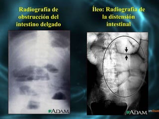 Radiografía de
obstrucción del
intestino delgado
Íleo: Radiografía de
la distensión
intestinal
 