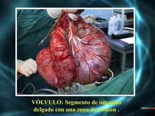 VÓLVULO: Segmento de intestino
delgado con una zona de torsión .
 