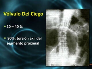 Vólvulo Del Ciego
20 – 40 %
 90%: torsión axil del
segmento proximal
 