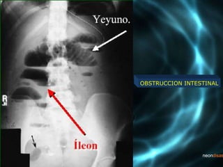 OBSTRUCCION INTESTINAL
 