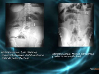 Abdomen simple. Asas dilatadas
con nivel hidroaéreo. Distal se observa
collar de perlas (flechas).
Abdomen simple. Niveles hidroaéreos
y collar de perlas (flechas).
 