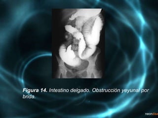 Figura 14. Intestino delgado. Obstrucción yeyunal por
brida.
 