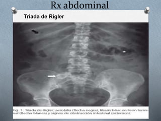 Triada Rigeler ABDOMEN AGUDO OBSTRUCTIVO FINAL.pptx