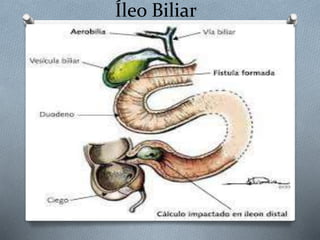 Triada Rigeler ABDOMEN AGUDO OBSTRUCTIVO FINAL.pptx
