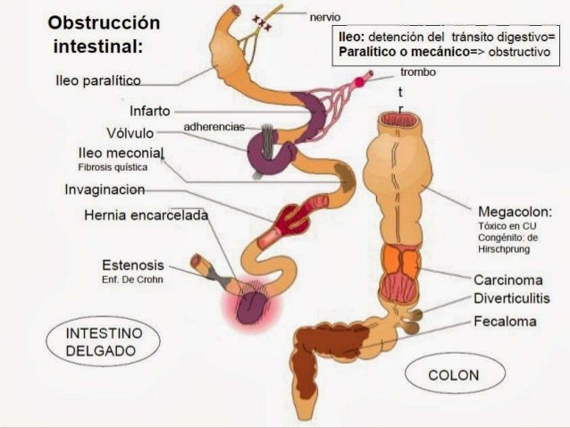Dieta para obstrucción intestinal