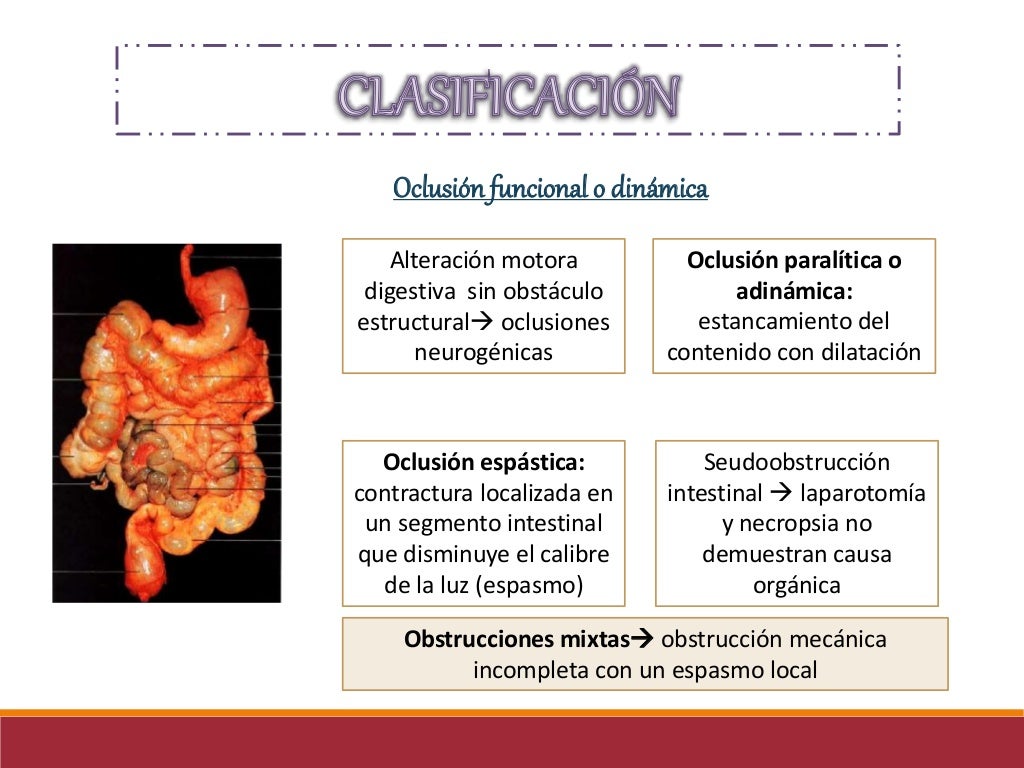 Abdomen agudo obstructivo