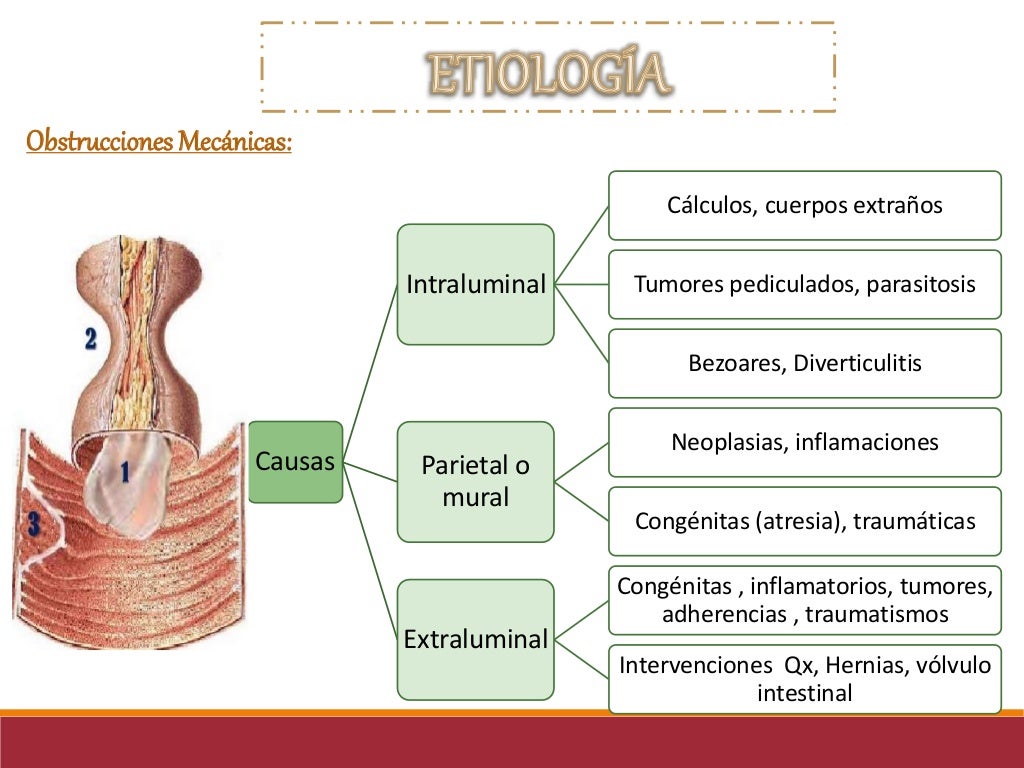 Abdomen agudo obstructivo